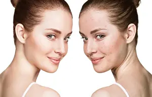 Comparison portrait of young girl with problematic skin before and after treatment