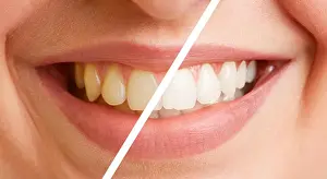 Dentist Prints: Comparison of teeth of a young woman before and after a tooth cleaning