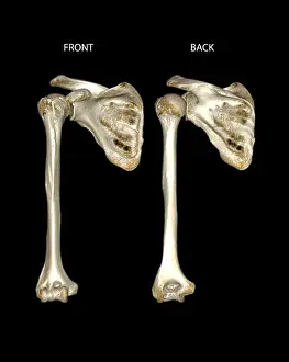 Disability Prints: Computed Tomography Volume Rendering examination of the shoulder joint