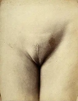 Advancement Prints: Cosmetic surgery: post-operative stage: a woman's pubes