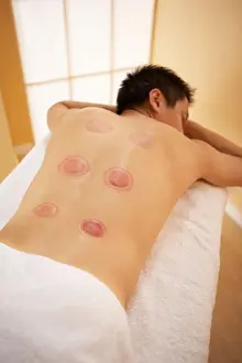 Remedy Prints: Cupping. Client with red marks on his back after receiving cupping therapy