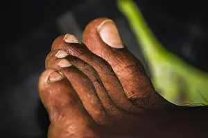 Ankle Prints: Dark skin man foot - Close-up toenail Fungus - Nail Fungus on Legs of black man