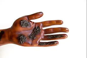 Wound Prints: Third degree severe burn injury on a dummy hand