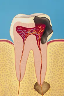 Dental Prints: DENTAL ABSCESS, DRAWING
