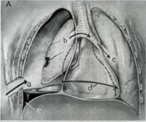 Wound Prints: Description discusses the mechanics and procedures involved in treating sucking chest wounds