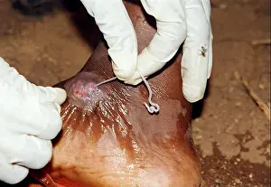 Extract Prints: Dracunculus medinensis, Guinea Worm Extraction