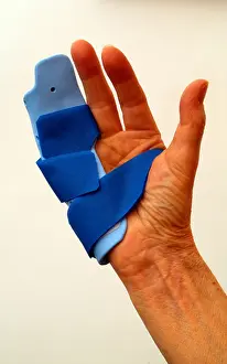 Orthopedic Prints: Dupuytrens Contracture Clinical Night Splint Fitting to Fingers and Hand