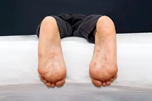 Sensitive Prints: Dyshidrotic eczema skin disease on sole of foot against white background