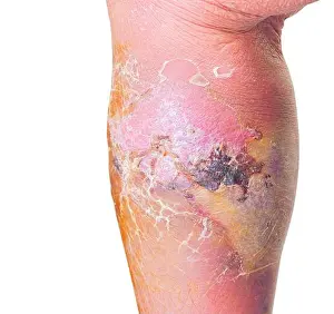 Inflammation Prints: Erysipelas bacterial infection Under the skin leg aged people On white background