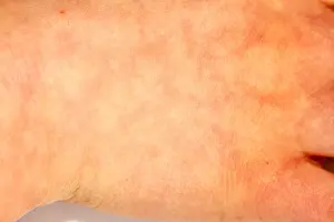 Rash Prints: Erythema ab igne or heat dermatitis also known as hot water bottle rash
