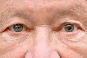 Pupils Prints: Extreme close up of an elderly man suffering from anisocoria showing unequal dilation of his pupils caused by an