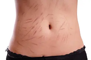 Depressive Prints: female tummy with scars from deliberate self-harm