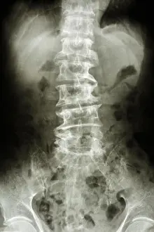 Black Body Prints: film X-ray show bent lumbar spine and spurs of old people (spondylosis patient), (spine )