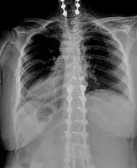 Black Body Prints: Film xray or radiograph of a mid back thoracic