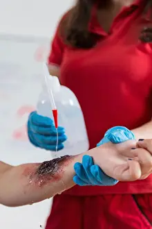 Hurt Prints: First aid training. Burn injury. First aid course