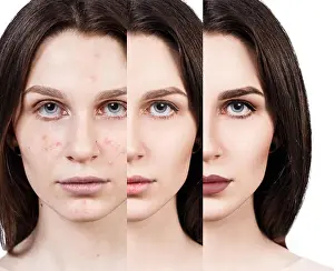 Young Girl Prints: Girl with acne before and after treatment