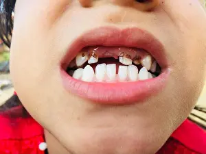 Dentistry Prints: A girl with open mouth showing her teeth for checking her cavity infection and toothache