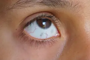 Mexico Prints: Grey spots in the white part of the eye of a young girl, Ocular Melanosis