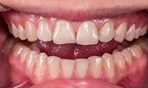Dentistry Prints: Healthy human teeth with normal occlusion from frontal intraoral view