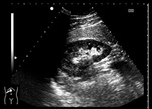 Sonography Prints: Healthy kidney, ultrasound scan