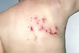 Viral Prints: HERPES ZOSTER ON BACK