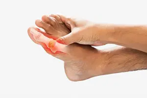 Inflammation Prints: High levels of uric acid in men's toes bones on a gray background
