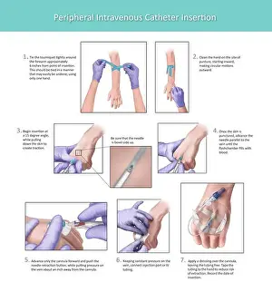 Illustration depicting the proper placement of a peripheral intravenous catheter insertion