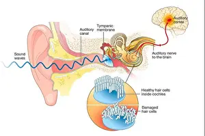 Ringing Prints: Illustration showing tinnitus. Damaged hair cells inside cochlea, labeled