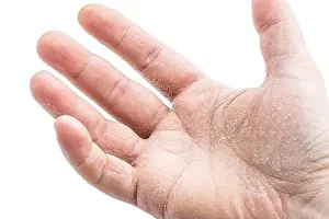 Dermatoses Prints: image of the mens hand showing skin disease isolated on white background