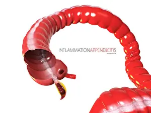 Inflammation Prints: Inflammantion Appendicitis concept, human intestine anatomy as a 3D illustration
