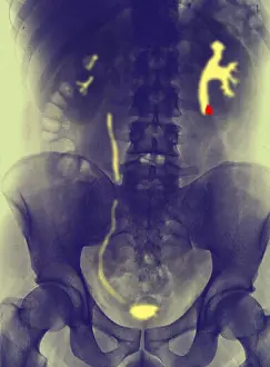 Ventral Prints: Kidney stone x ray