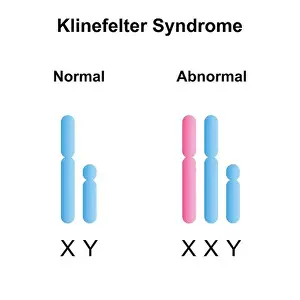 Symptoms Prints: Klinefelter syndrome, illustration