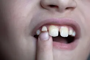 Dentistry Prints: loss of a baby tooth in an eight-year-old child, at the last stage