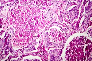 Pathology Prints: Lung adenocarcinoma, light micrograph, photo under microscope
