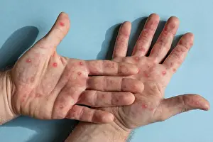 Sensitive Prints: Male hands with Monkeypox rash