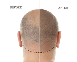 Worry Prints: Man before and after hair loss treatment on white background