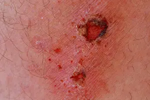 Knee Prints: Man with a wound on his knee wound on his leg