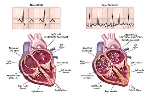 Symptoms Prints: Medical illustration showing the symptoms of a heart with atrial fibrillation compared to normal one