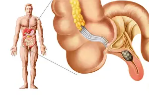 Magnification Prints: Medical ilustration of an appendix with appendicitis