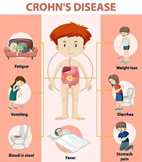Fatigue Prints: Medical infographic of Crohn's Disease illustration