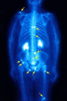Examine Prints: METASTASIS, SCINTISCAN