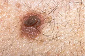 Dermatology Prints: Mole (soft naevus) on the skin