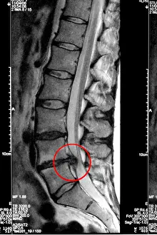 Transparency Prints: MRI scan clearly showing a slipped disc pressing on the spinal cord with the affected area circled in red