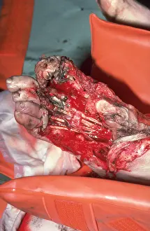 Trauma Prints: Multiple injuries hit by underground train