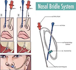A nasal bridle attaching a nasogastric tube to the nasal septum to prevent accidental pullout