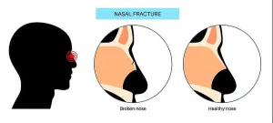 Patient Prints: Nasal fracture, illustration.