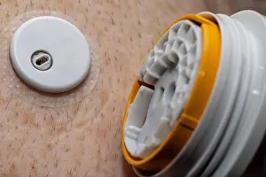 Short Hair Prints: New, clean continuous glucose monitoring sensor applicator on upper arm