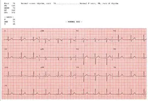 Sinus Prints: Normal electrocardiogram