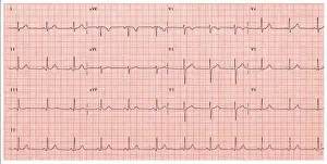 Sinus Prints: Normal electrocardiogram
