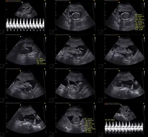 Screening Prints: Normal obstetrical ultrasound including Döppler